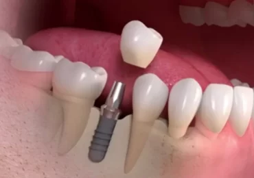Dental Implants in Islamabad