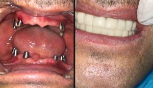 Full mouth fix teeth on 12 implants